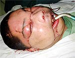 Chins dorme aps receber transplante de face