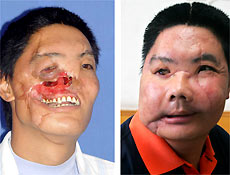 Li Guoxing horas antes da cirurgia e hoje