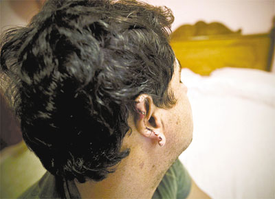 J.C.G., 42, que foi agredido em feira em So Joo da Boa Vista (SP), mostra a orelha decepada