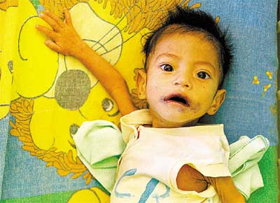 Miguel, de 11 meses, que est desnutrido, em Dourados (MS)